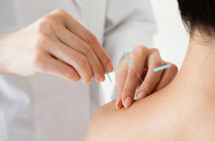 Châm cứu là một trong những cách điều trị đau cổ vai gáy